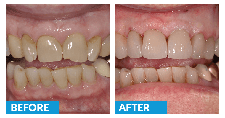 Closeup of Janet's smile before and after treatment