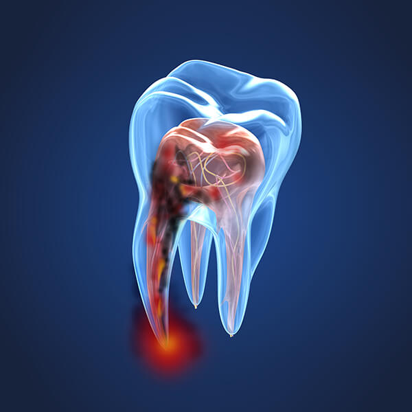 An illustration of the damage inside a tooth in need of a root canal