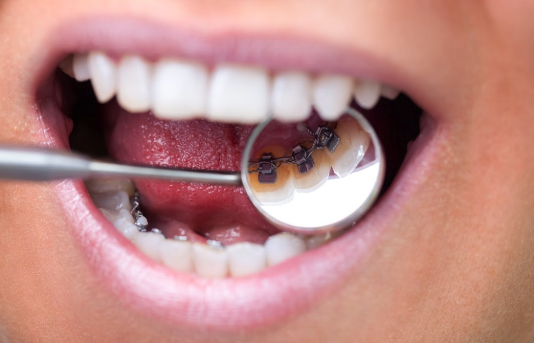 Lingual Braces: A Comprehensive Guide to Invisible Orthodontics