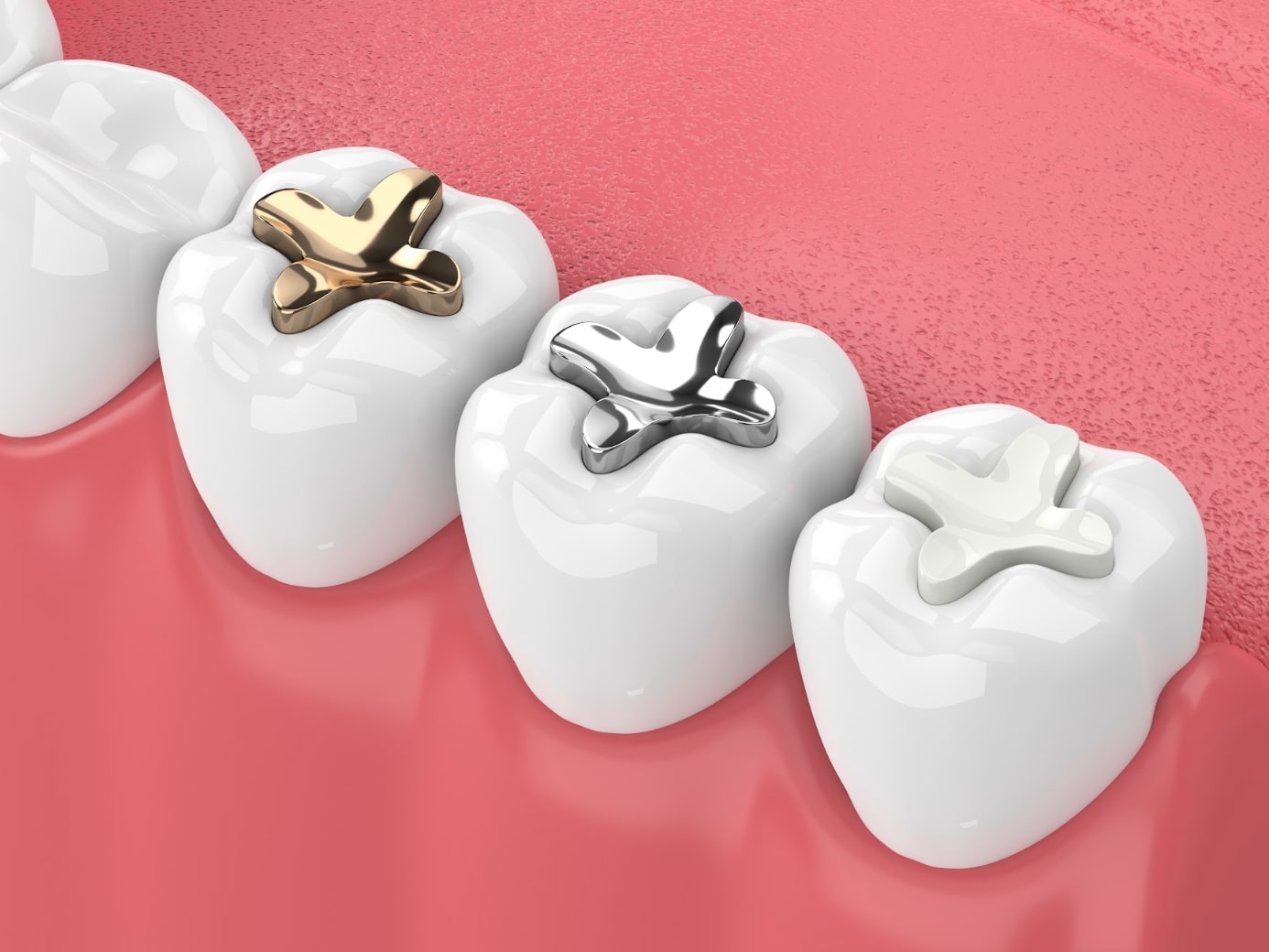Image with three different fillings in teeth - Gold, Silver, and White
